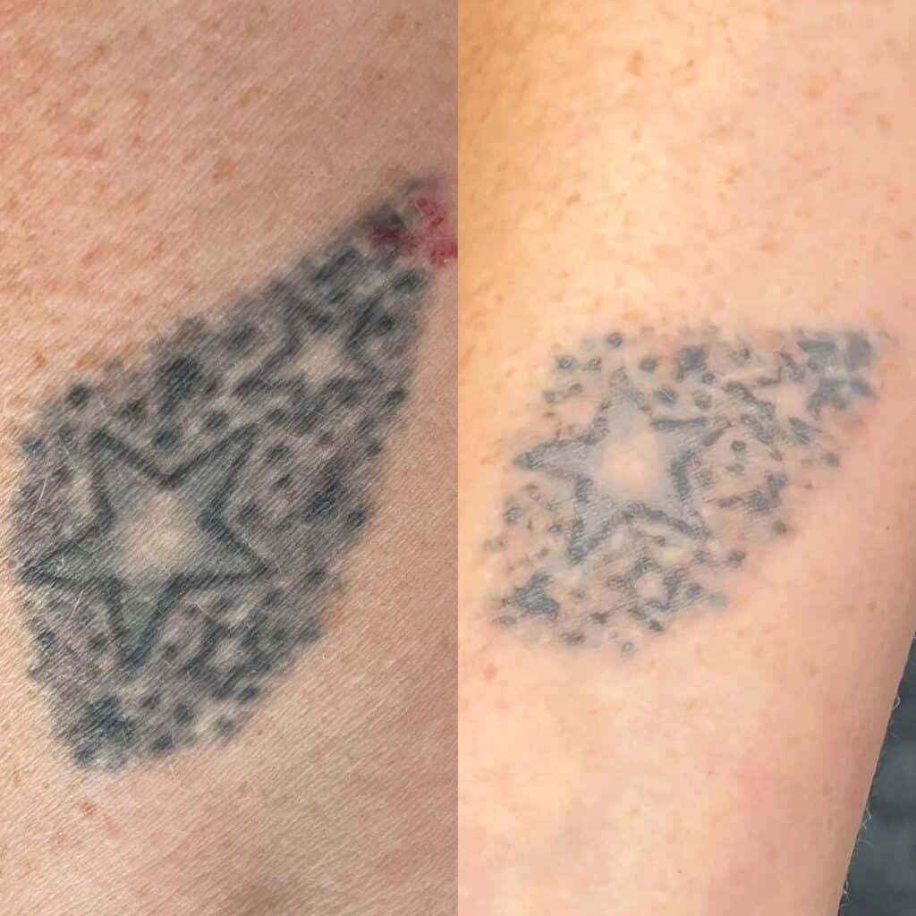 tattoo removal in Derbyshire