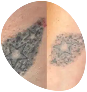 Tattoo is neverforever with our laser tattoo removal service in Derbyshire. Stars being removed by tattoo removal.