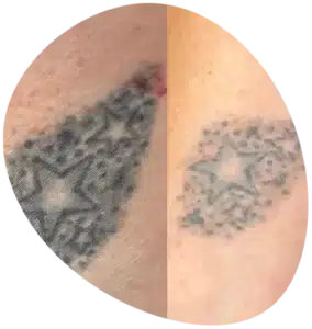 Tattoo is neverforever with our laser tattoo removal Derby service in Derbyshire. Stars being removed by tattoo removal in derby.