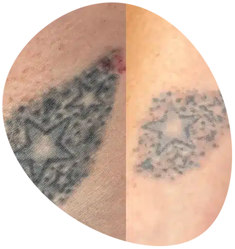 Tattoo is neverforever with our laser tattoo removal Derby service in Derbyshire. Stars being removed by tattoo removal in derby.