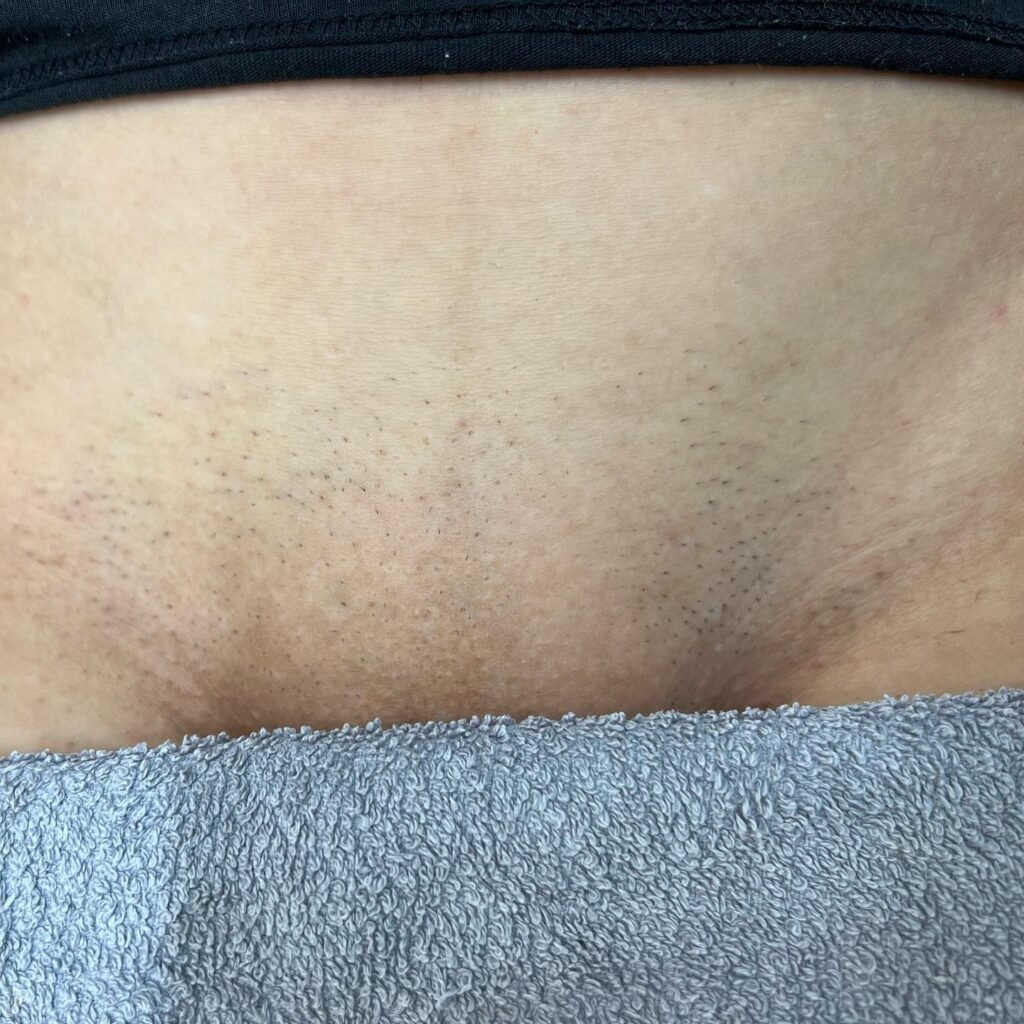 Bikini line after 1 session of hair removal with our amazing laser in Derbyshire near nottingham