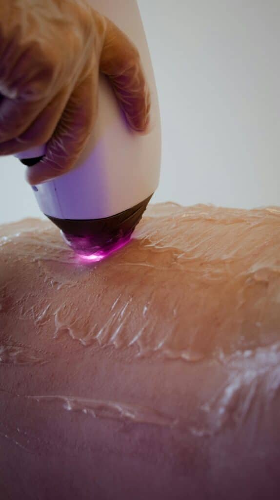 laser hair removal treatment