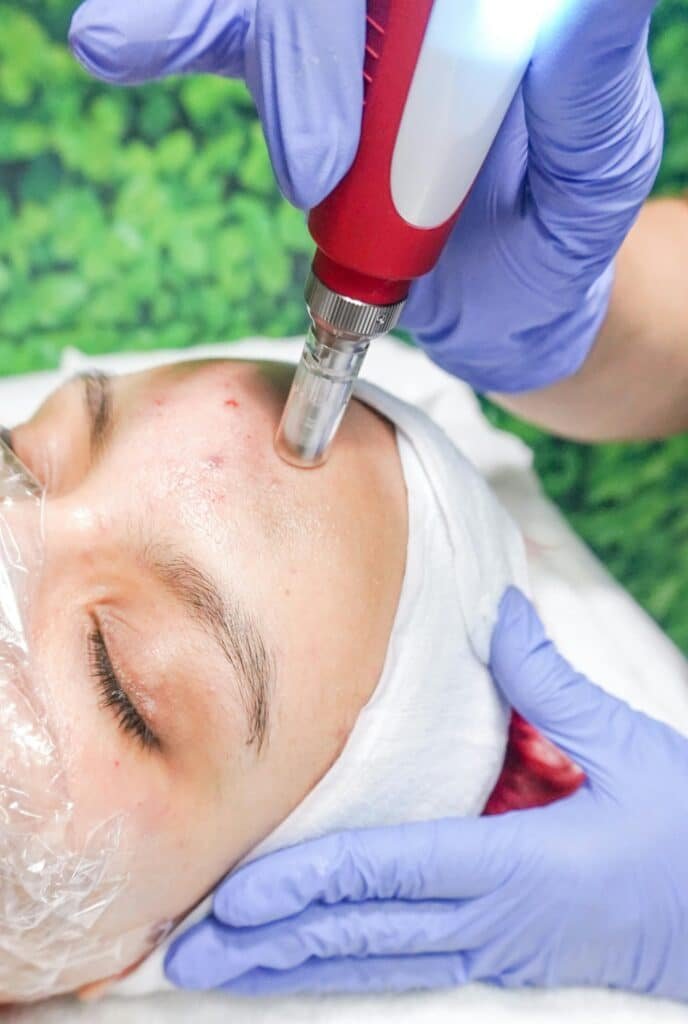 acne treatment