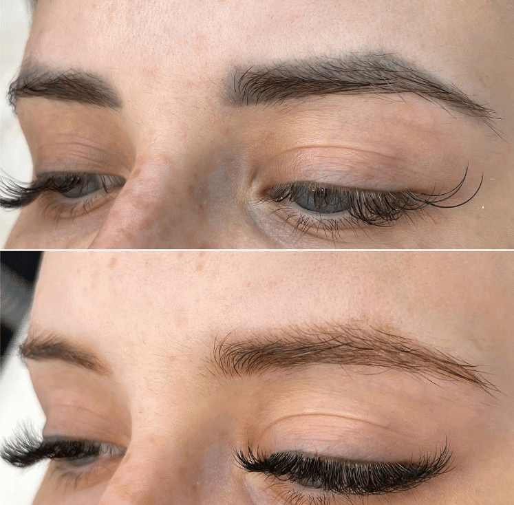 Laser Microblading Removal