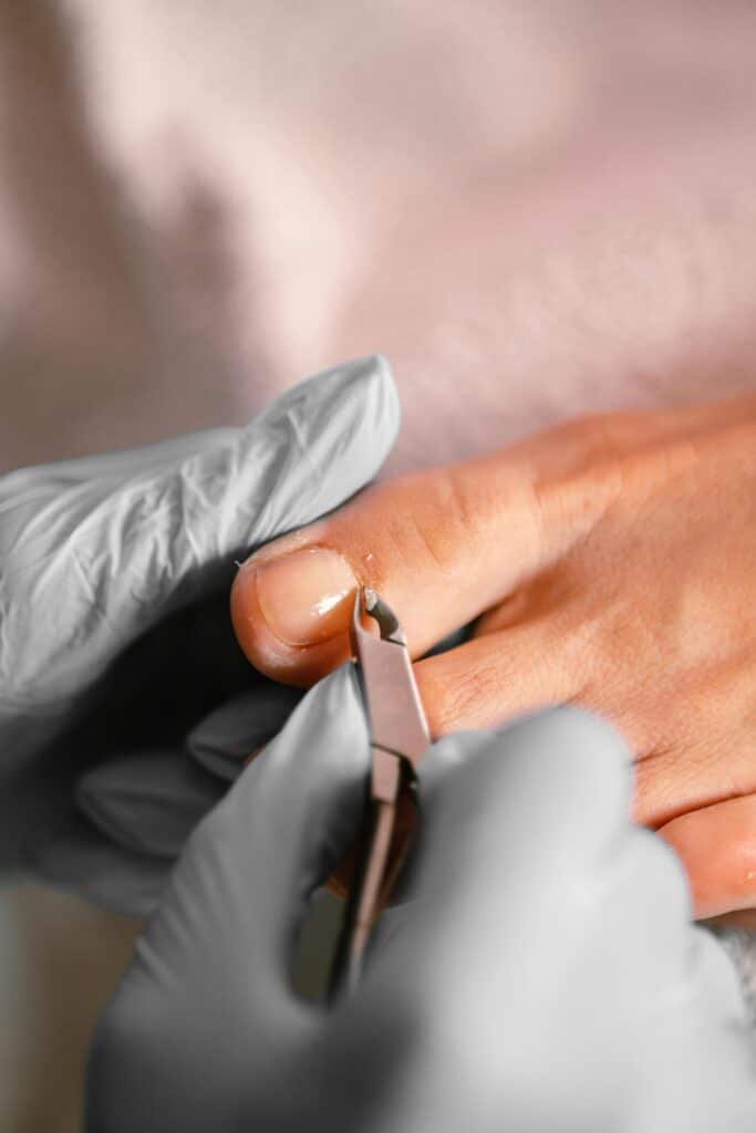 Nail Fungal Infection