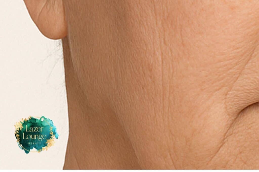 Sagging Jowls Treatment at Lazer Lounge