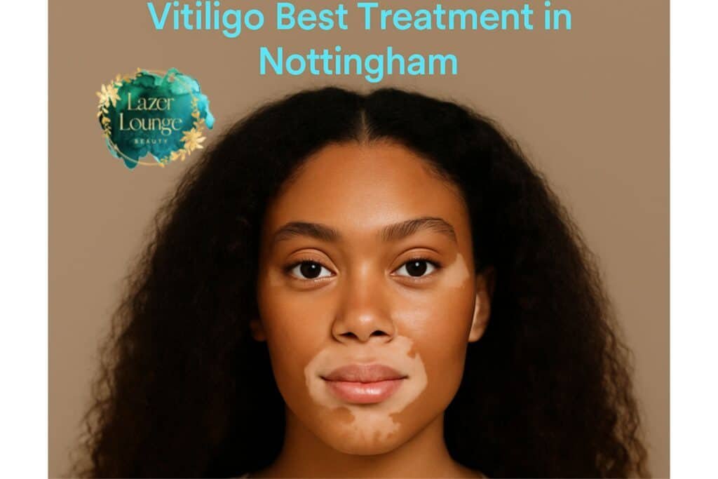 Vitiligo Treatment at Lazer Lounge