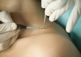 Laser Removal Treatment of Skin Tags