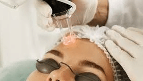 Laser Skin Resurfacing Treatment