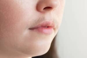 facial hair removal