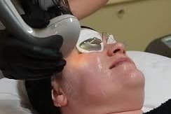 Limelight Laser Treatments