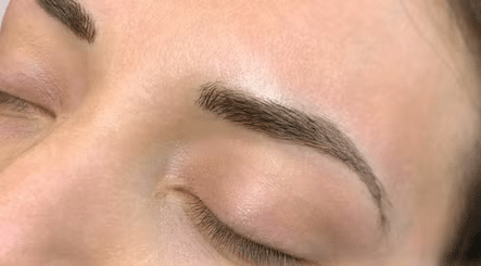 Laser SPMU Removal