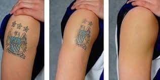Best Tattoo Laser Near Me