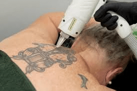 Lazer Lounge Tattoo Removal Treatment