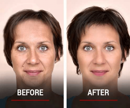 Scalp Micropigmentation Removal