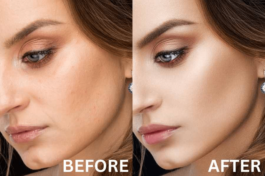 Antioxidants for Melasma