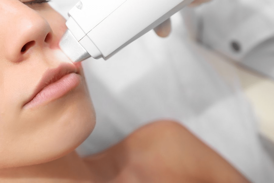 Upper Lip Laser Hair Removal Treatment in Derby