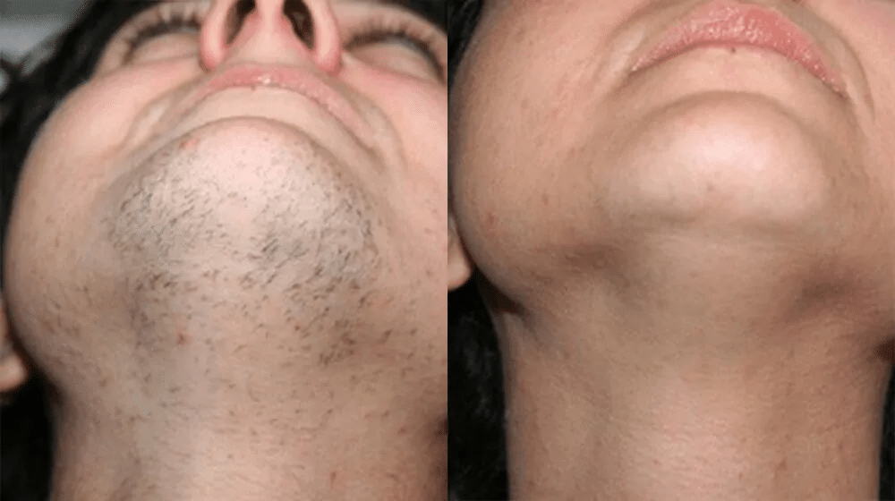 Chin Laser Hair Removal in Derby