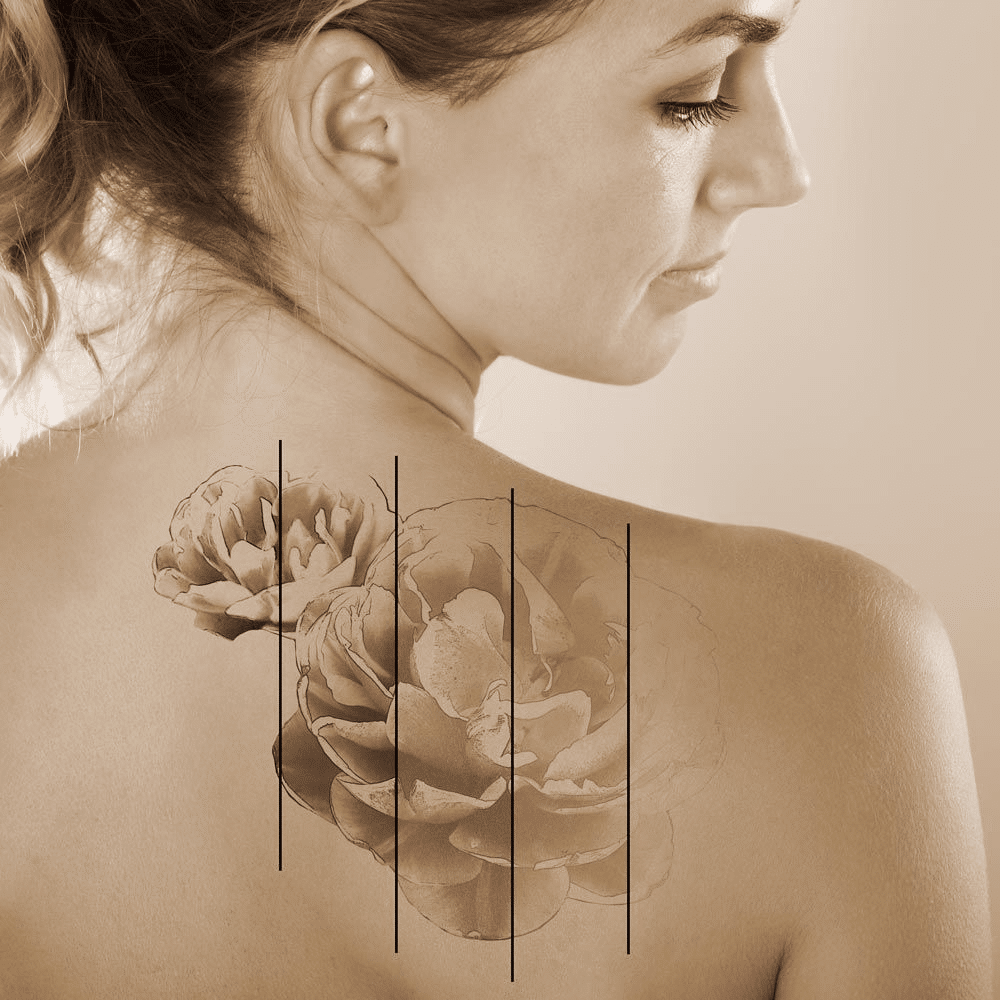 Tattoo Removal from Back