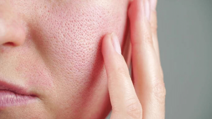 Shrink Enlarged Pores
