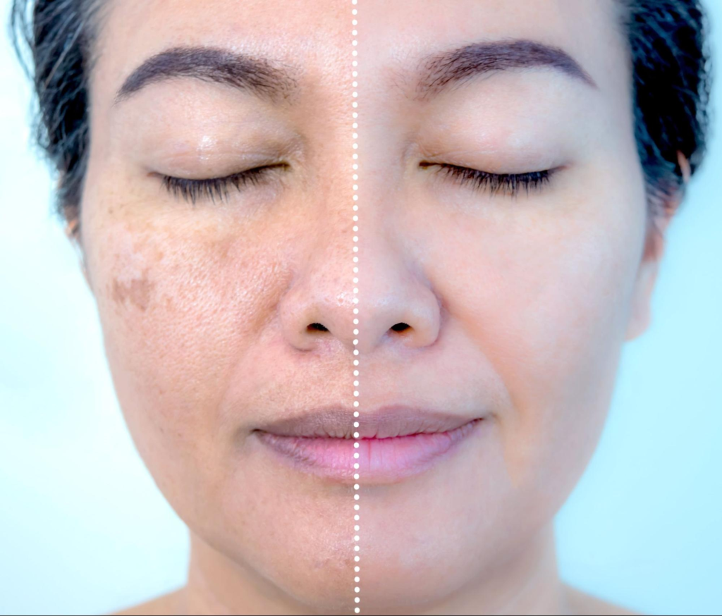 Professional Treatments for Post-Summer Pigmentation