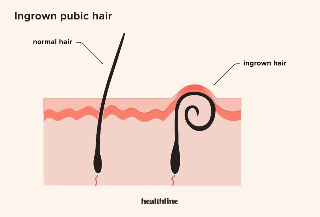 Causes Of Ingrown Pubic Hair