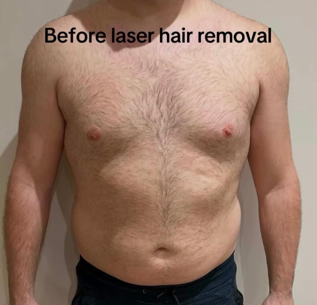Man's chest and abdomen before laser hair removal treatment showing natural hair growth before starting laser hair removal for men.