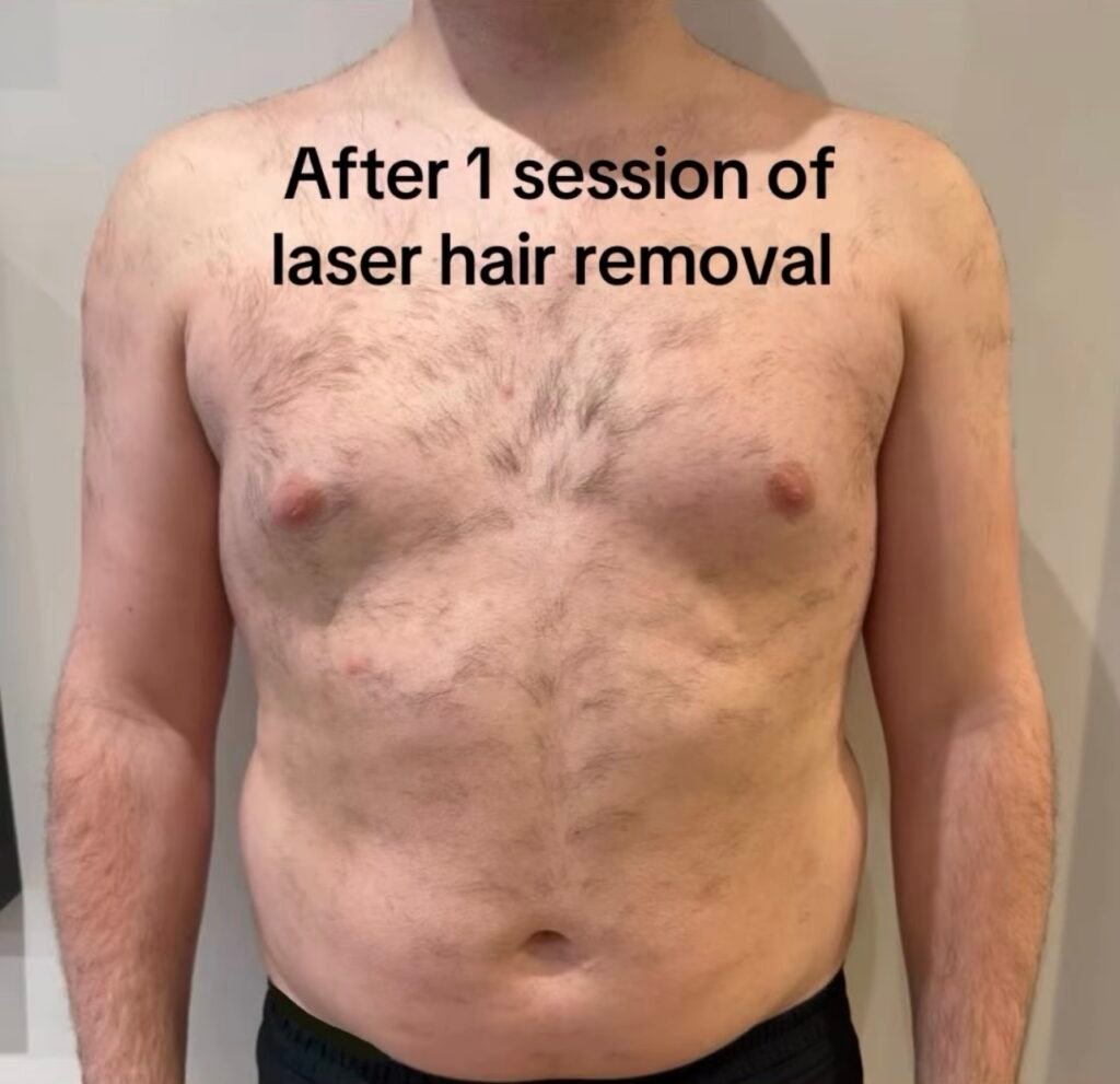 Male chest after one laser hair removal session showing reduced hair growth and patchy shedding on the chest and stomach.