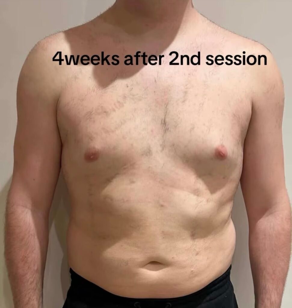 Laser hair removal men before and after results showing significant chest hair reduction four weeks after the second treatment session.
